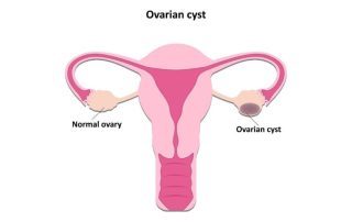 Ovarian Cysts and Fertility